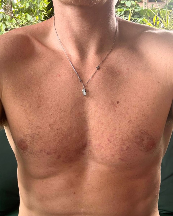 The same client's chest, clear, after 12 weeks