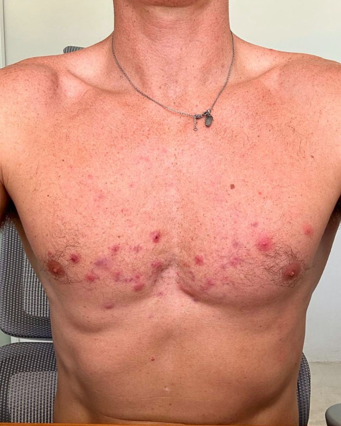 Client's chest with cystic acne before the protocol