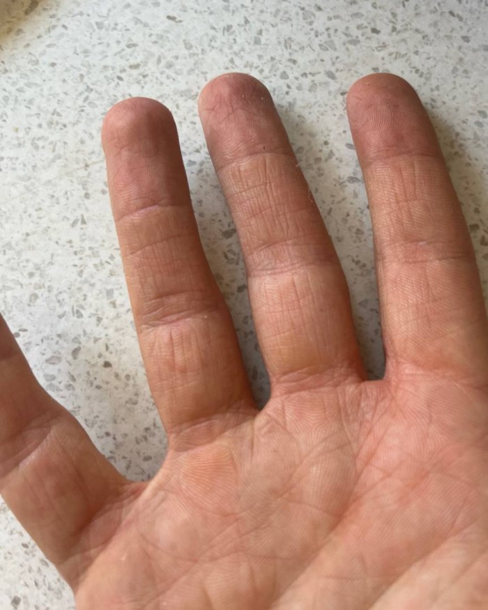 The same client's hands, clear, less than 8 weeks later