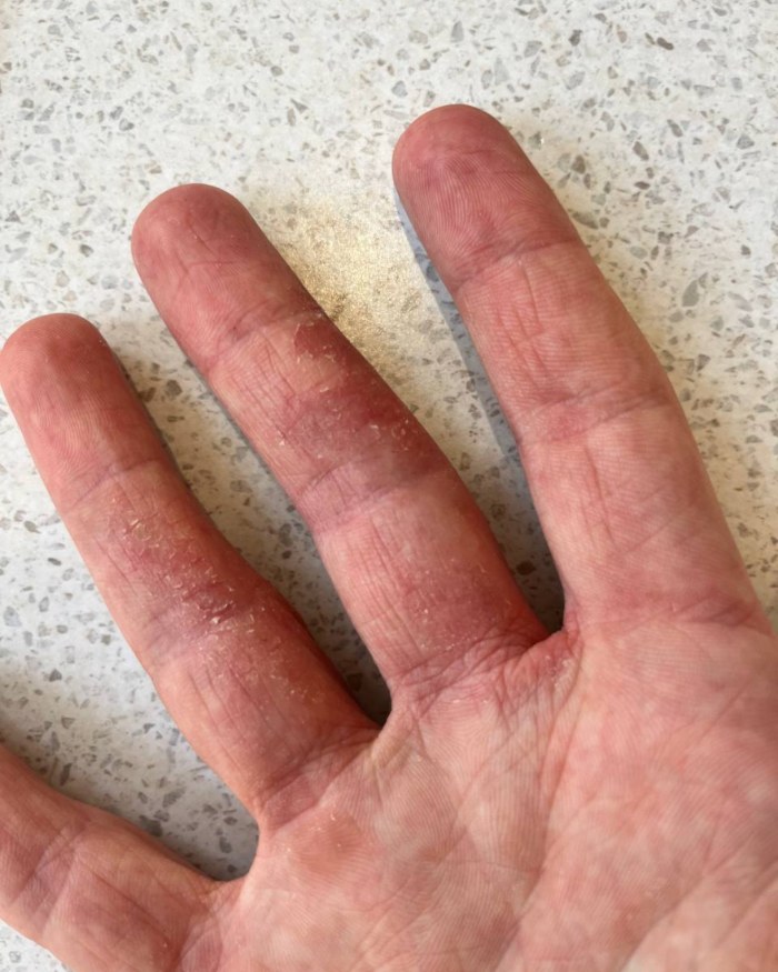 Client's hands with eczema before the protocol