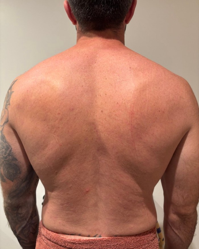 The same client's back, clear, 12 weeks later