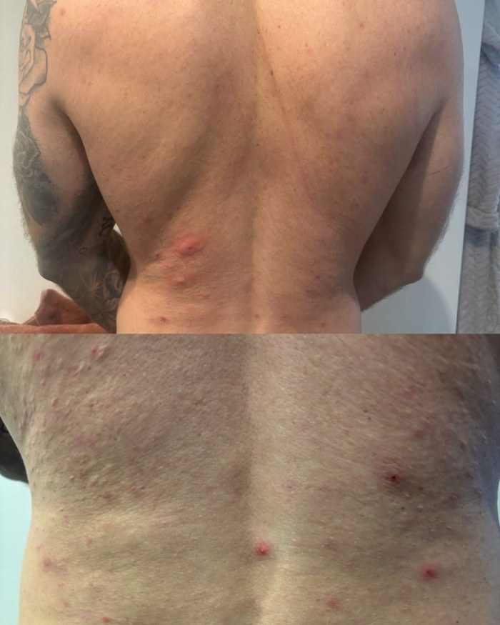 Client's back with acne before the protocol